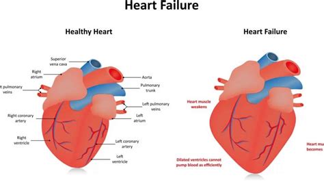 severe global Lv hypokinesis